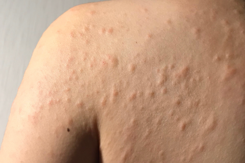 Allergy Symptoms: Hives