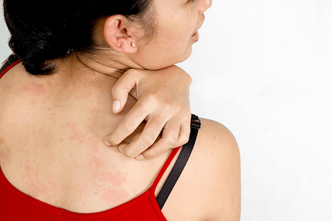 Allergy Symptoms Hives