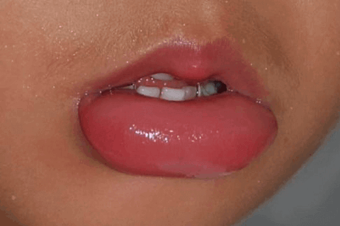 Allergy Symptoms Swollen Lips