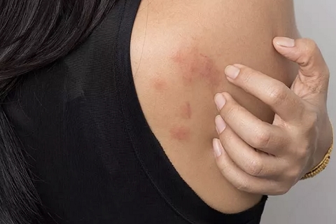 Allergy Symptoms: Skin rashes